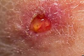 this image shows a small leg ulcer