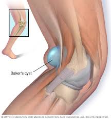 this image shows a Bakers cyst , which is a swelling commonly found at the back of the leg