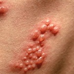 this image shows the watery blisters that shingles causes