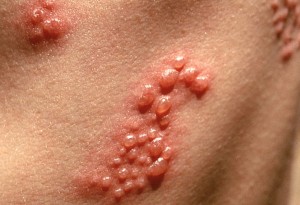 this image shows the watery blisters that shingles causes