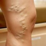 this image shows leg with varicose veins that extend above the knee